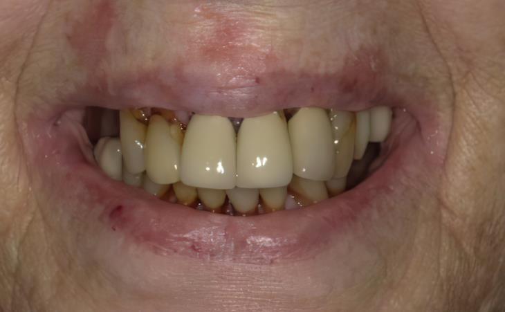 Immediate Dental Implants Before