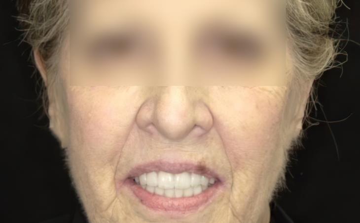 Front View - After Results of Immediate Implants