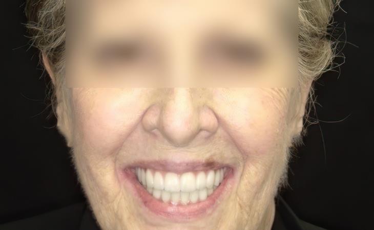 Immediate Dental Implants Results