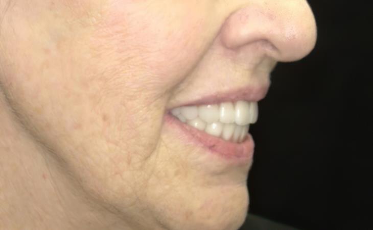 After Immediate Implants – Side View