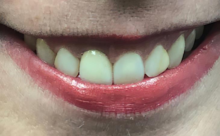 After using Dental Implant for Broken Tooth Replacement
