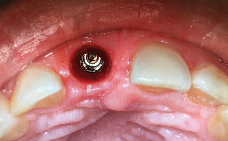 Site of Dental Implant for Broken Tooth