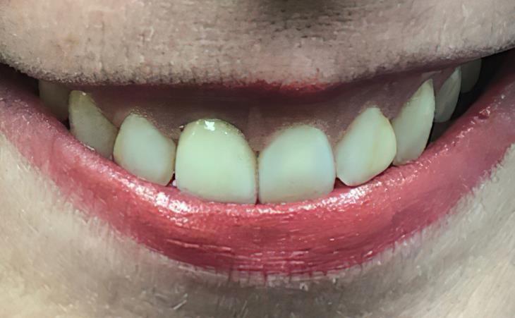 After using Dental Implant for Broken Tooth Replacement