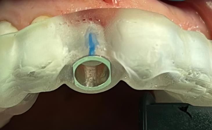 Front Tooth Guided Implant Placement