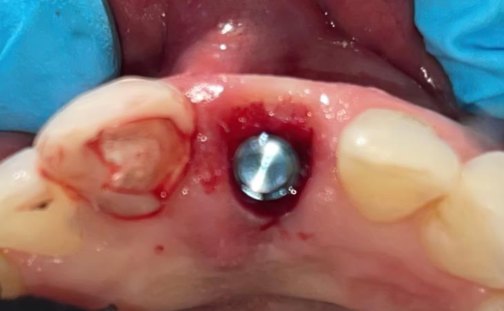 Front Tooth Replacement Implant Site