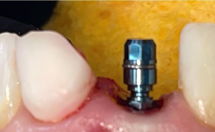 Placing Dental Implant in Front Tooth