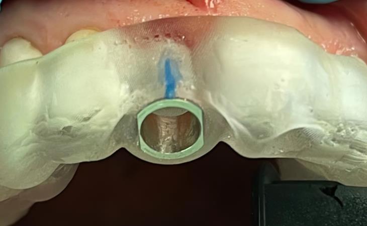 Guided Implant Placement for Missing Front Tooth