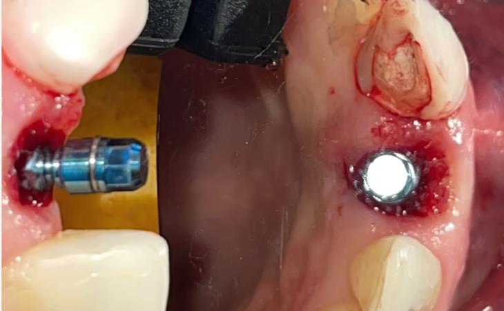 Front Tooth Implant – Side View
