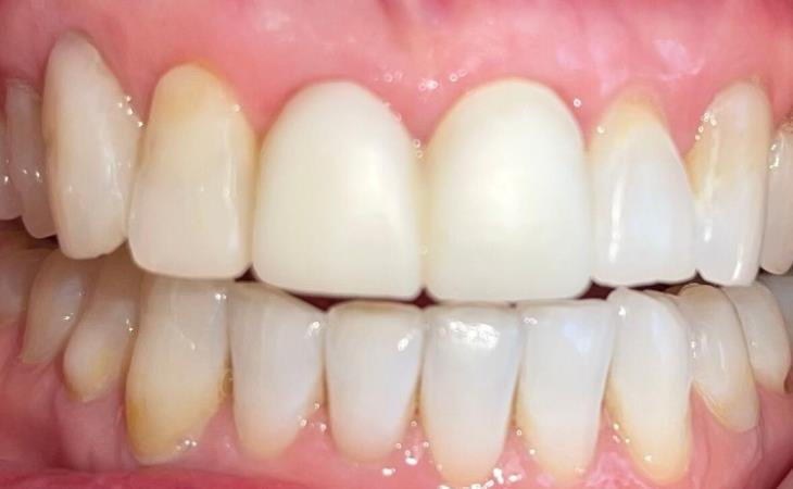 Front Tooth with Implant After