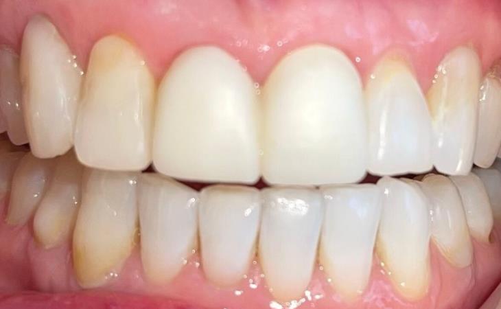 After – Missing Front Tooth with Dental Implant