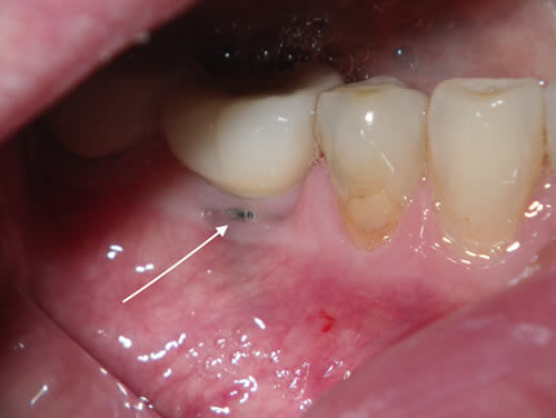 Dental Implant Complication Before Dental Implant Complication Before