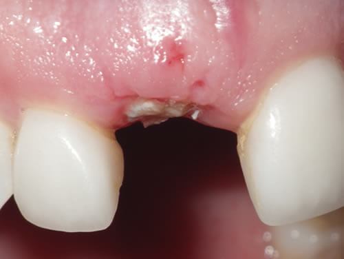 Tooth Replacement Before Tooth Replacement Before