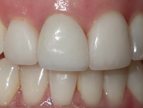 Tooth Replacement After Tooth Replacement After