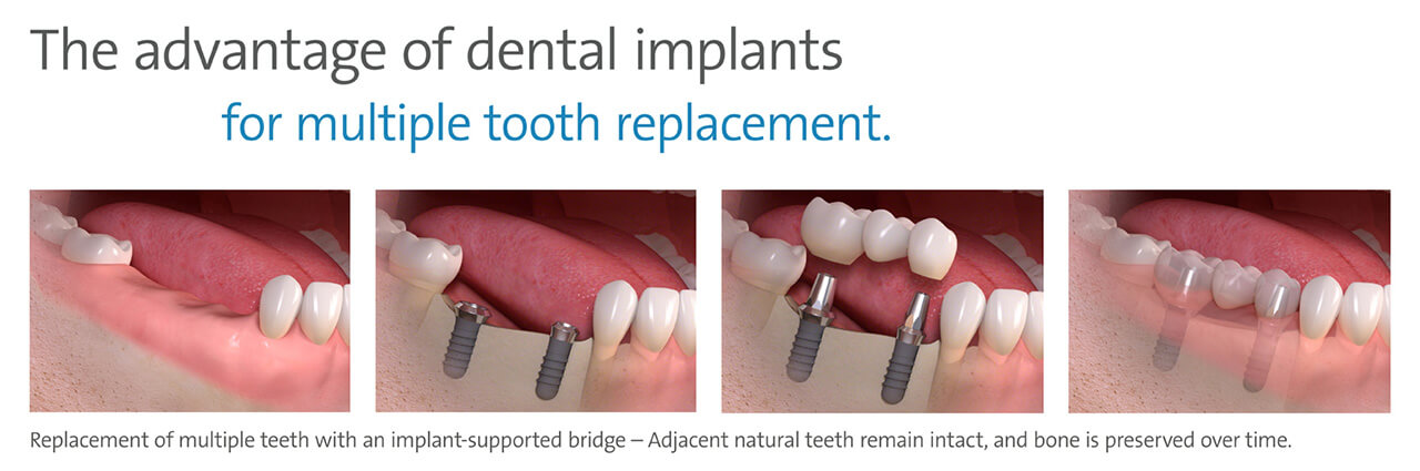 Advantages Of Dental Implants