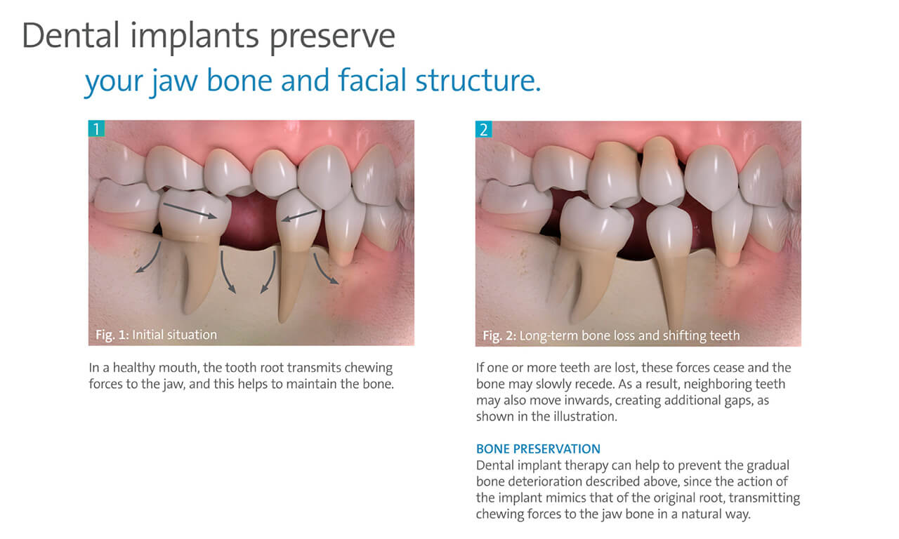 Dental Implants Preserve Your Jaw Bone and Facial Structure
